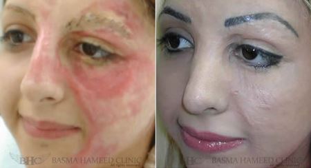باورنکردنی از بازسازی صورت سوخته این زن با تاتو (عکس)