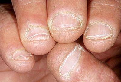از مدل و تغییرات ناخن به بیماری های پی ببرید (عکس)