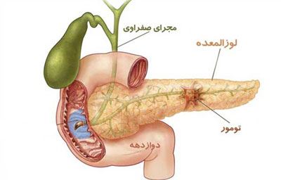 نشانه های بیماری لوزالمعده (عکس)