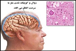 بیماری کروتزفلد جاکوب چیست و چه نشانه هایی دارد