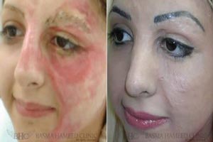 باورنکردنی از بازسازی صورت سوخته این زن با تاتو (عکس) باورنکردنی از بازسازی صورت سوخته این زن با تاتو (عکس)