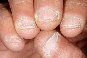 از مدل و تغییرات ناخن به بیماری های پی ببرید (عکس) از مدل و تغییرات ناخن به بیماری های پی ببرید (عکس)