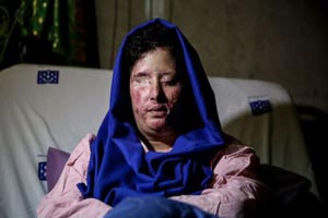 خبرهای تازه از قربانی اسید پاشی در اصفهان (تصاویر)