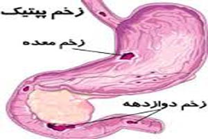 شایع ترین نشانه زحم معده