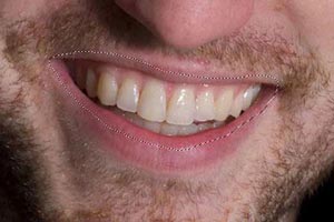 آموزش تصویری سفید کردن دندانها در فتوشاپ برای عکس