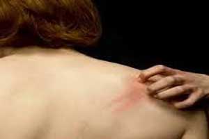 راه های کاهش خارش پوستی