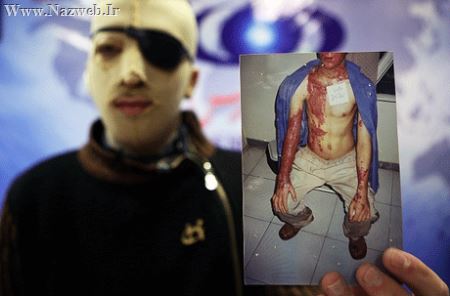 +16 ناگفته های دردناک پسر جوان قربانی اسید پاشی (تصاویر)
