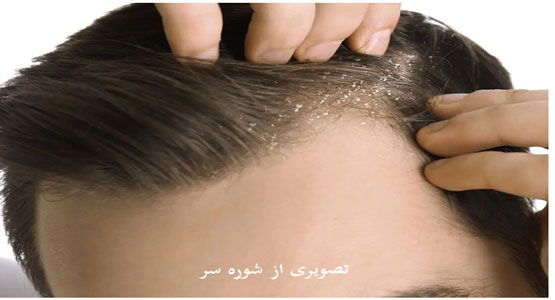 تفاوت شوره سر با قارچ