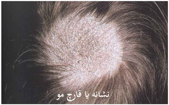 تفاوت شوره سر با قارچ