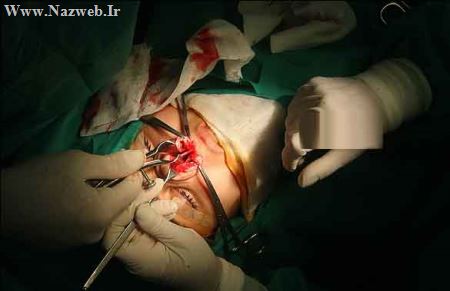 تصاویری از عمل جراحی زیبایی دماغ (18+)