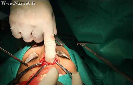 تصاویری از عمل جراحی زیبایی دماغ (18+)