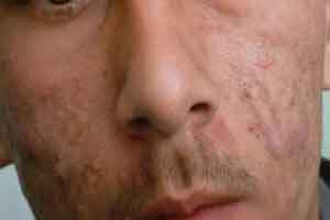تخلیه جوشها در منزل به روش حرفهای ها تخلیه جوشها در منزل به روش حرفهای ها