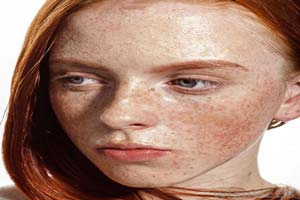 راه های جلوگیری از ایجاد کک و مک راه های جلوگیری از ایجاد کک و مک