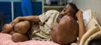 وحشتناک ترین تومور 7 کیلویی صورت در قرن (عکس 18-)