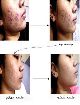 جوانسازی چینی پوست صورت و ... افزایش حجم لب (عکس)