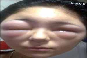اثر دیوانه وار نیش زنبور روی صورت این افراد (عکس)