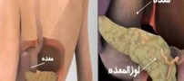 سرطان لوزالمعده چه نشانه هایی دارد