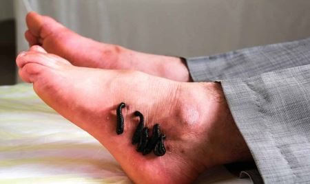 عکس های حجامت و زالو درمانی در ایران (16-)