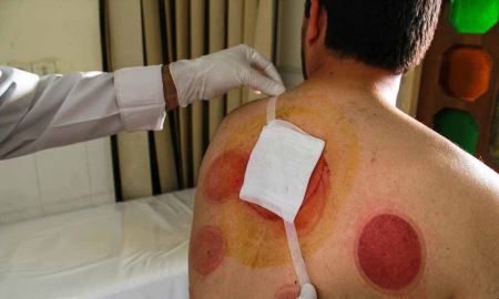 عکس های حجامت و زالو درمانی در ایران (16-)