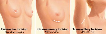 جراحی زیبایی سینه و نکات مهم جراحی (عکس)