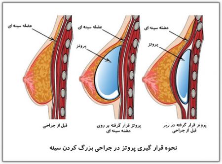 جراحی زیبایی سینه و نکات مهم جراحی (عکس)