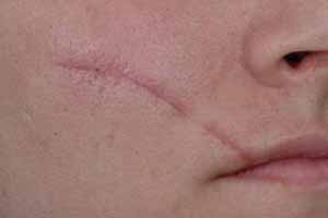 چرا جای زخم روی پوست می ماند؟ چرا جای زخم روی پوست می ماند؟