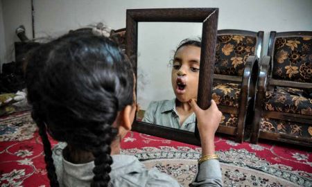 تنها دختر ایرانی بدون لب (عکس)