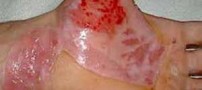 بهترین راه از بین بردن جای سوختگی پوست