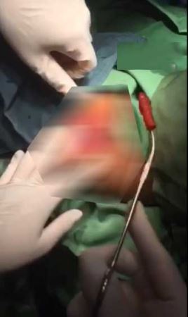 جنجال دوباره خارج کردن شیی از واژن دختر 8 ساله ایرانی (عکس)