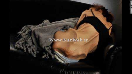 فیلم و عکس وحشتناک زنی که به بیماری بی اشتهایی عصبی دچار است (18+)