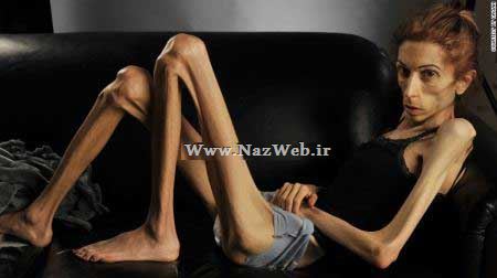فیلم و عکس وحشتناک زنی که به بیماری بی اشتهایی عصبی دچار است (18+)