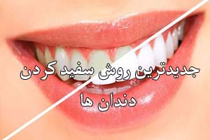جدیدترین روش برای سفید کردن دندان جدیدترین روش برای سفید کردن دندان