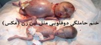 ختم حاملگی دوقلویی مثل این زن (عکس)