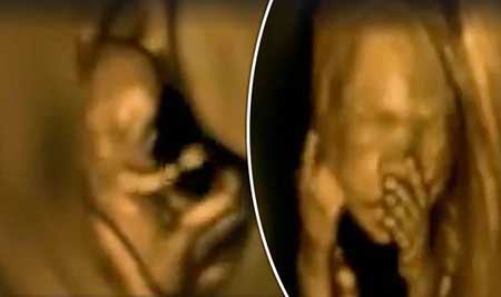عکس های حیرت انگیز رقص جنین در شکم مادر