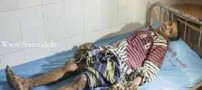 18+ عکس های تکان دهنده پسری با دردناک ترین بیماری دنیا