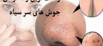 راحت ترین راه درمان جوش های ریز سرسیاه