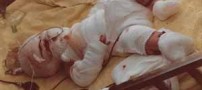 نجات عجیب نوزاد سرخ شده در روغن ! عکس 16+