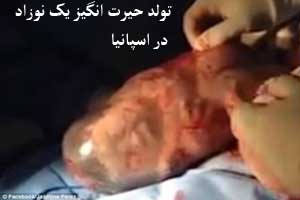 نوزادی که با تولد حیرت انگیز پزشکان را به چالش کشید! عکس نوزادی که با تولد حیرت انگیز پزشکان را به چالش کشید! عکس