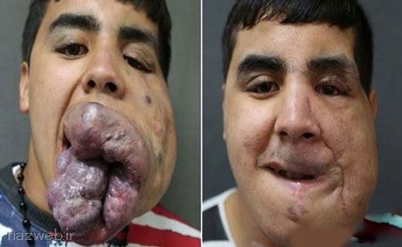 لب های پروتز شده و وحشتناک این پسر (عکس)