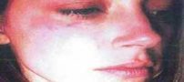 چهره کتک خورده خانم بازیگر از شوهرش (عکس)