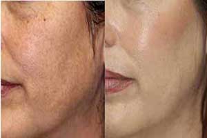 رفع طبیعی لکه های قهوه ای پوست رفع طبیعی لکه های قهوه ای پوست