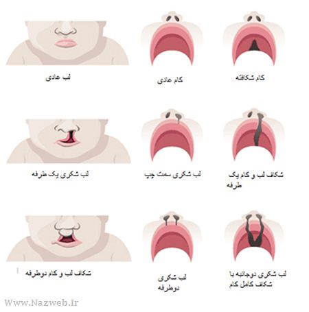 لب شکری شدن نوزادان چه دلیلی دارد (عکس)