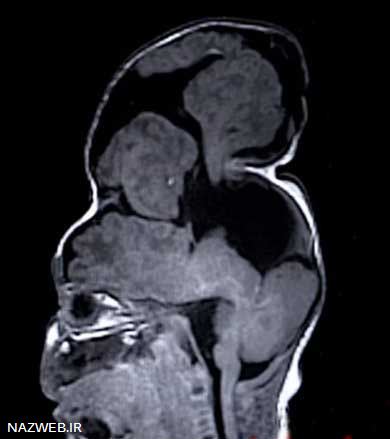 دختری، نادر با مغز بیرون زده (تصاویر)