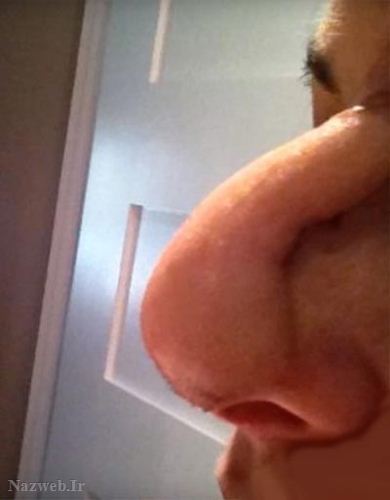 زنی با بینی وحشتناک بخاطر داروی تقلبی (عکس 18+)
