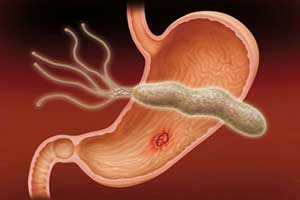 هلیکوباکتری یا میکروب معده چیست هلیکوباکتری یا میکروب معده چیست