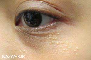 دلیل جوش های سفید زیر پوستی دلیل جوش های سفید زیر پوستی