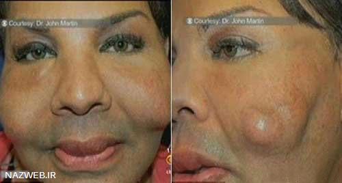 بوتاکس سیمانی یک زن به جای ژل زیبایی ! عکس