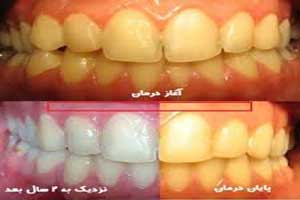 زردی دندان ها از چیست + راه درمان زردی دندان ها از چیست + راه درمان