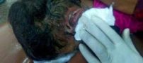 دختری که 80 کرم از گوشش بیرون کشید! تصاویر 18+