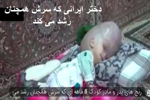 ویدئو وحشتناک دختر ایرانی که سرش همچنان رشد می کند